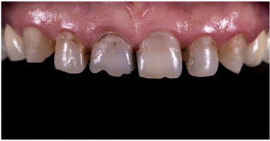 Before dental veneers | Dentist in Monroe and highland park nj
