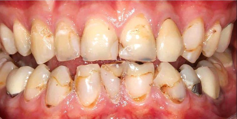 Before porcelain veneers done by our top rated family dentist in Monroe Township and Highland Park NJ