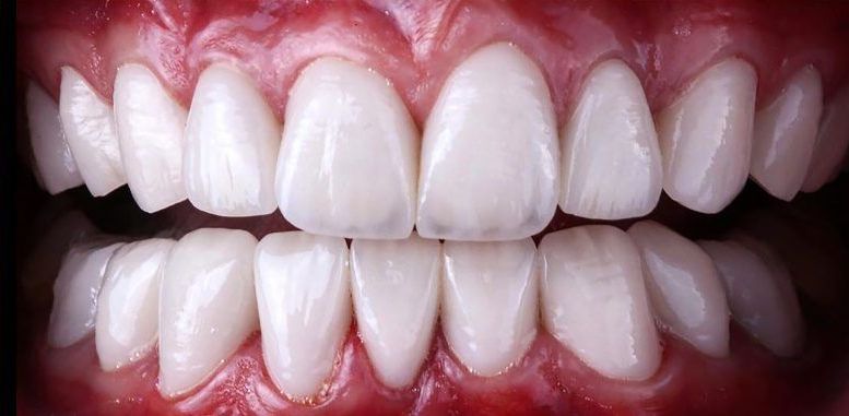 After porcelain dental veneers | smile makeover done by our highland park NJ dentist