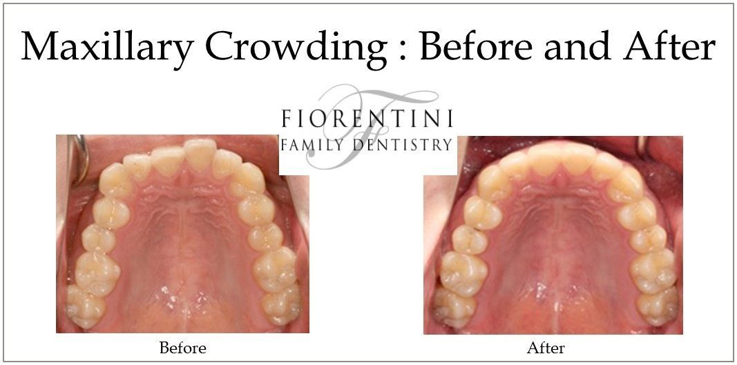 INVISALIGN