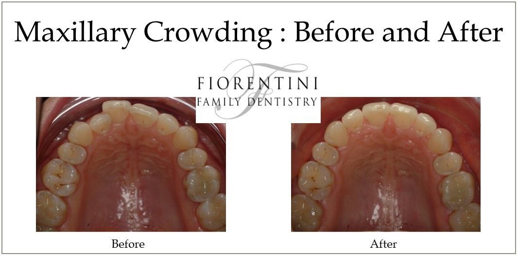 INVISALIGN