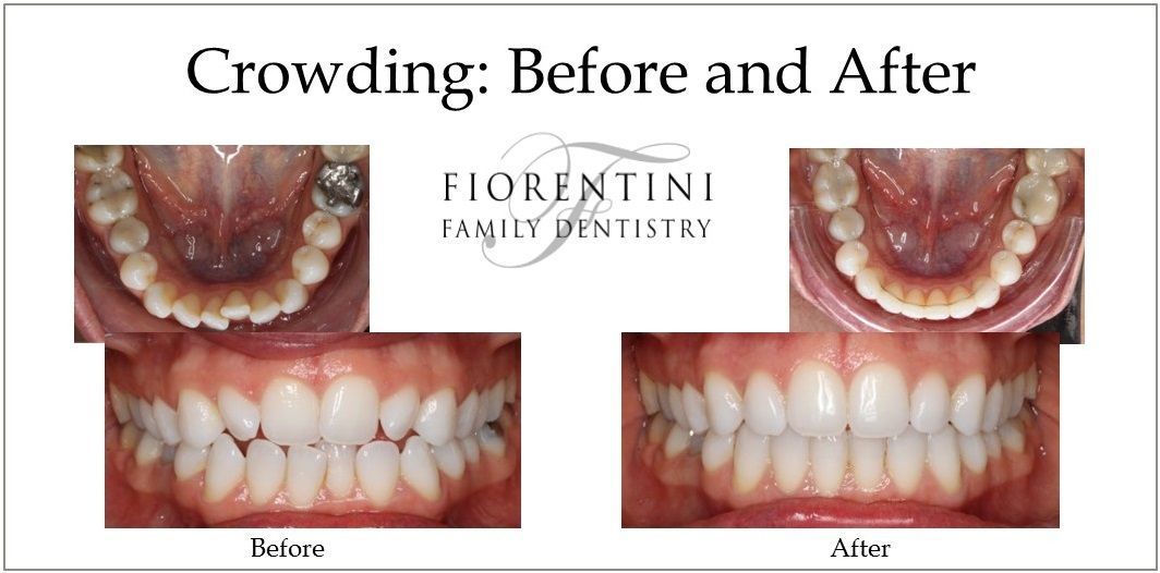 INVISALIGN