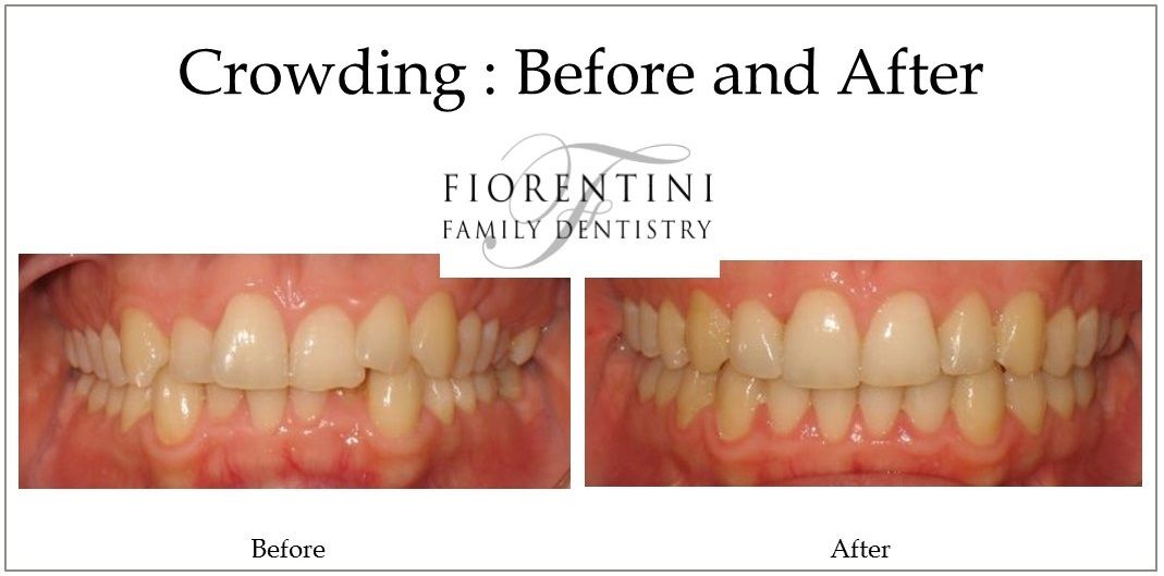 INVISALIGN