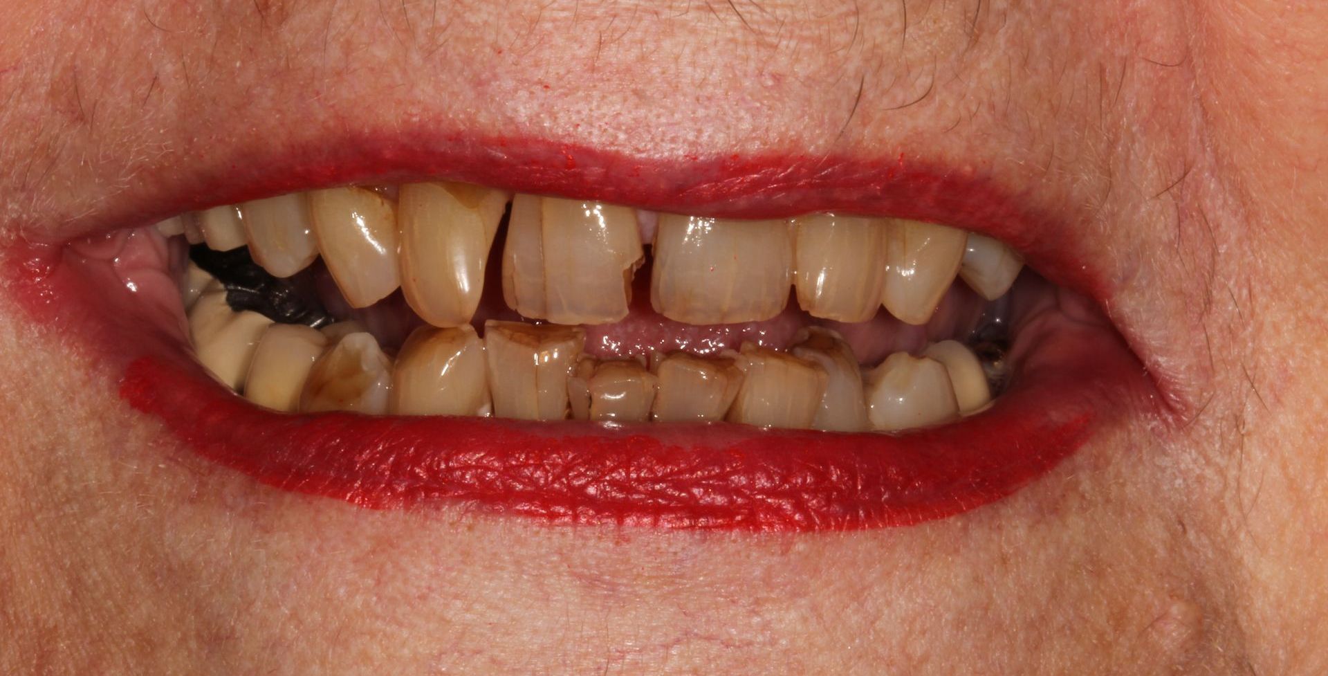 Messed up smile | Before dental crowns and veneers