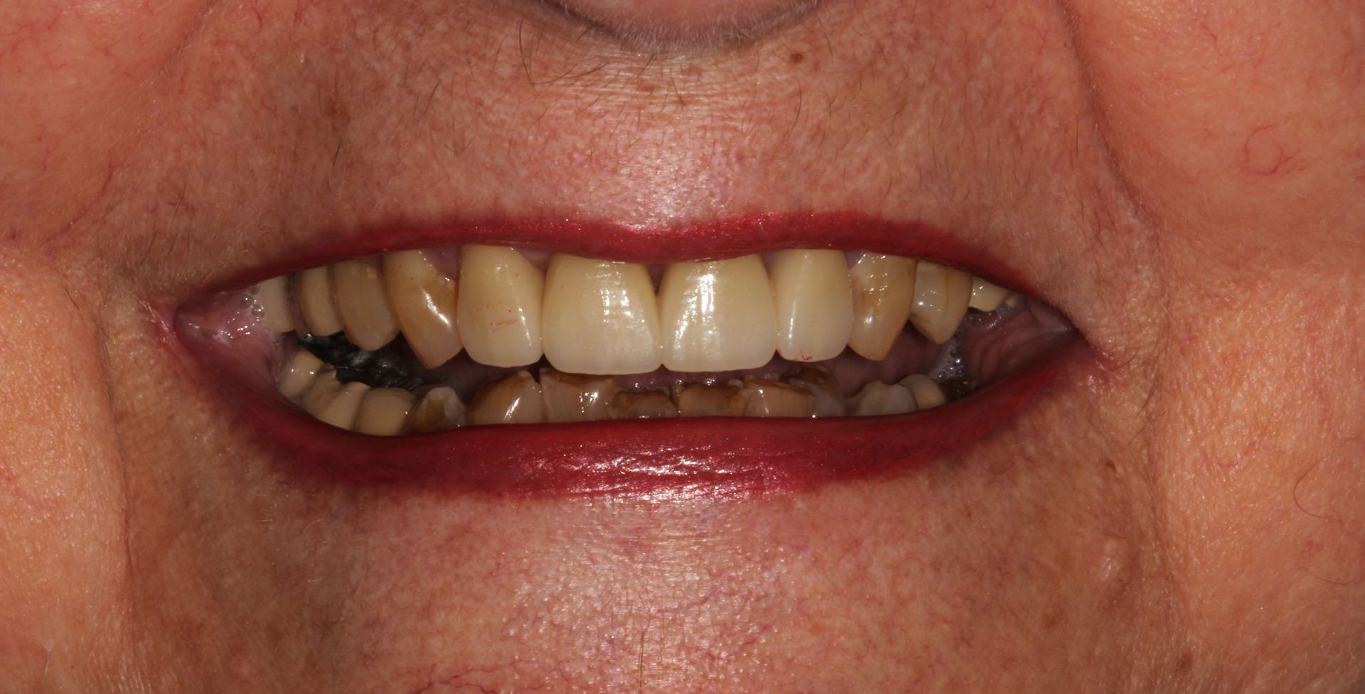 after dental crowns and veneers | Highland Park and Monroe Township 