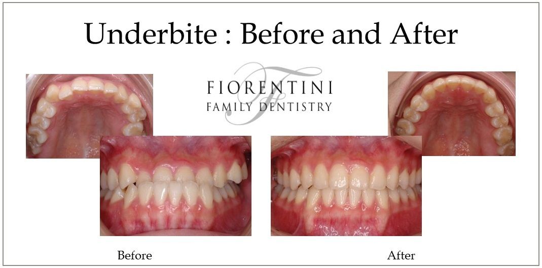 Underbite fixed | Best dentists in Highland Park and Monroe Township NJ