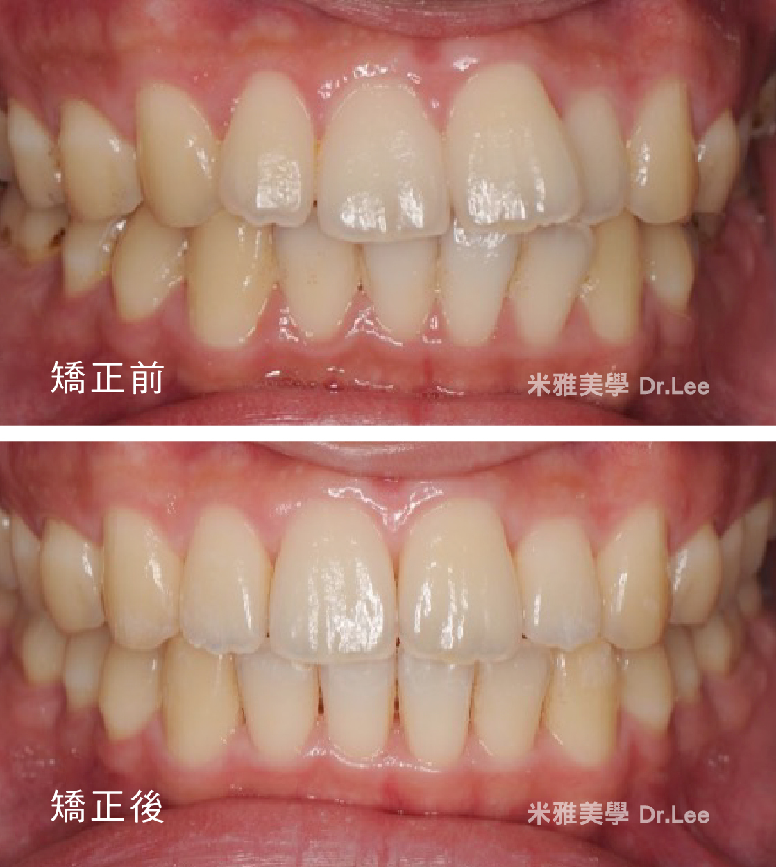 A before and after picture of a person 's teeth