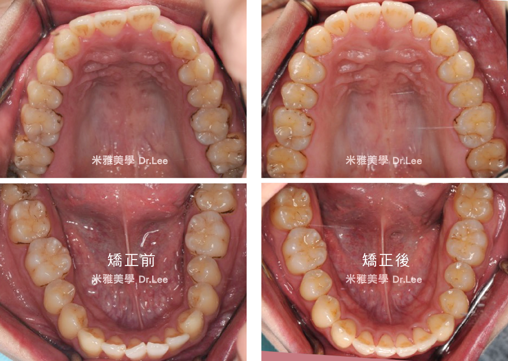 A close up of a person 's teeth with chinese writing on them