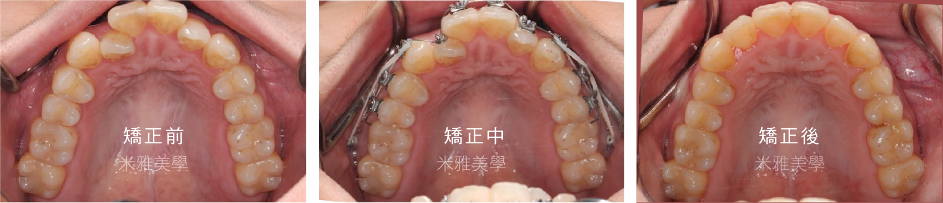 A close up of a person 's mouth with braces on their teeth.