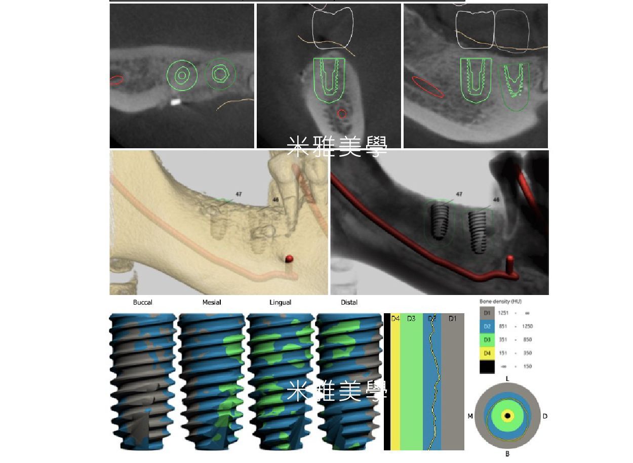 A collage of images of a tooth and dental implants