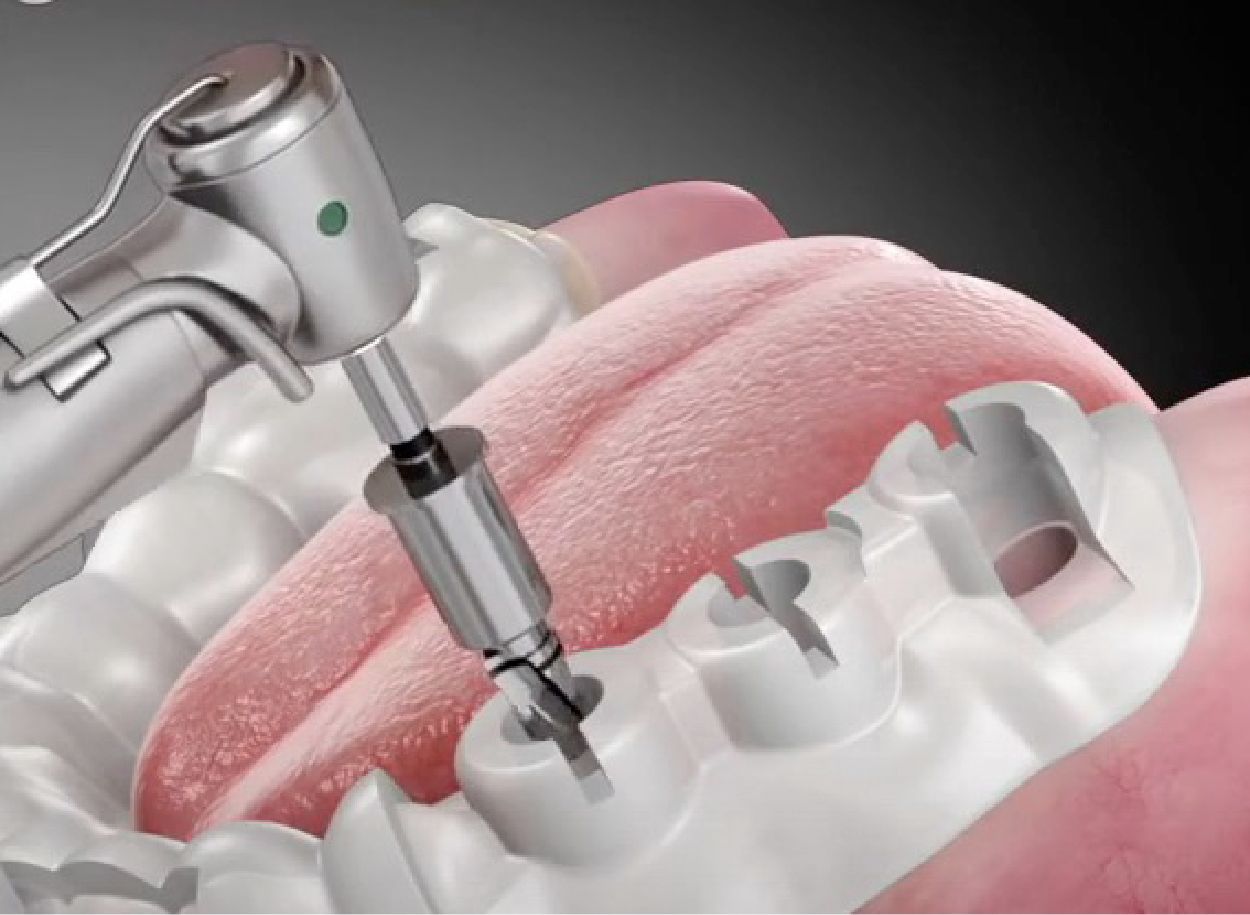 A close up of a person 's teeth being drilled by a machine.