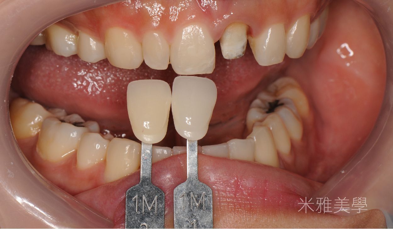 A close up of a person 's mouth with two tooth shades in it.