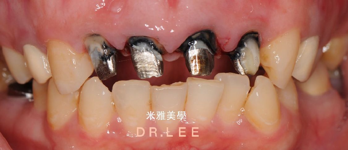 A close up of a person 's mouth with a lot of teeth missing.