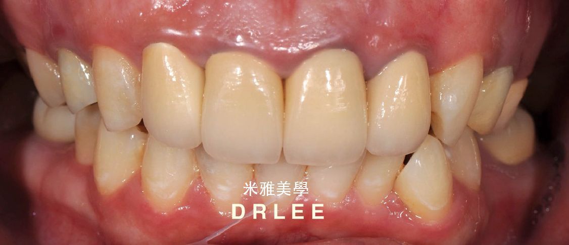 A close up of a person 's teeth and mouth.