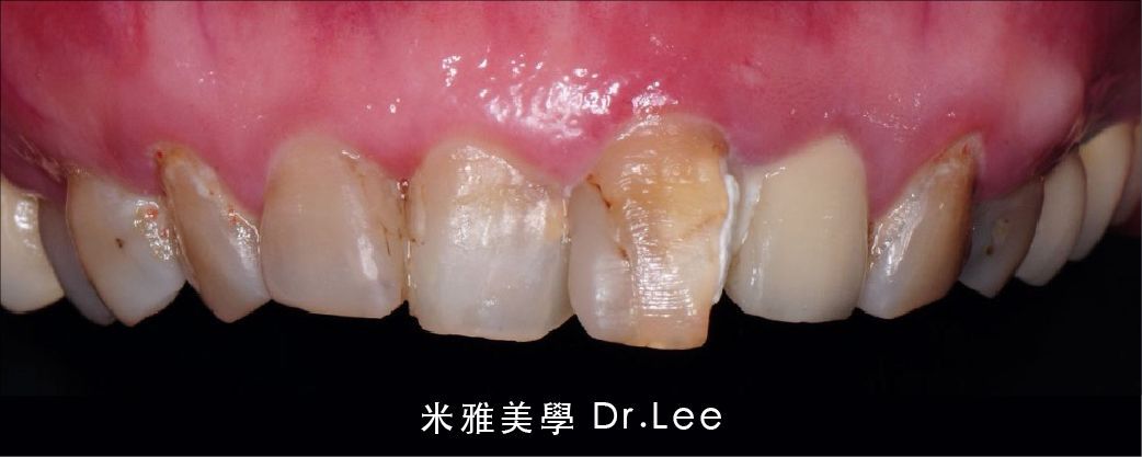 A close up of a person 's teeth with a tooth missing.