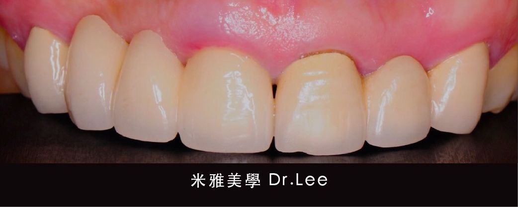 A close up of a person 's teeth with a broken tooth.