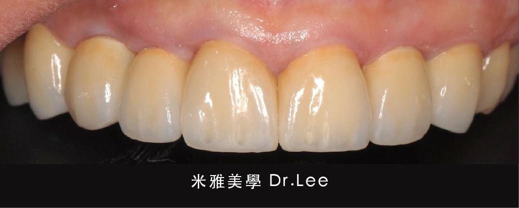 A close up of a person 's teeth with a black background.