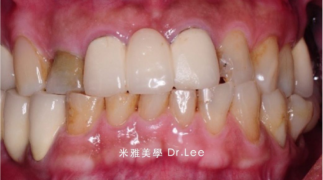 A close up of a person 's teeth and gums