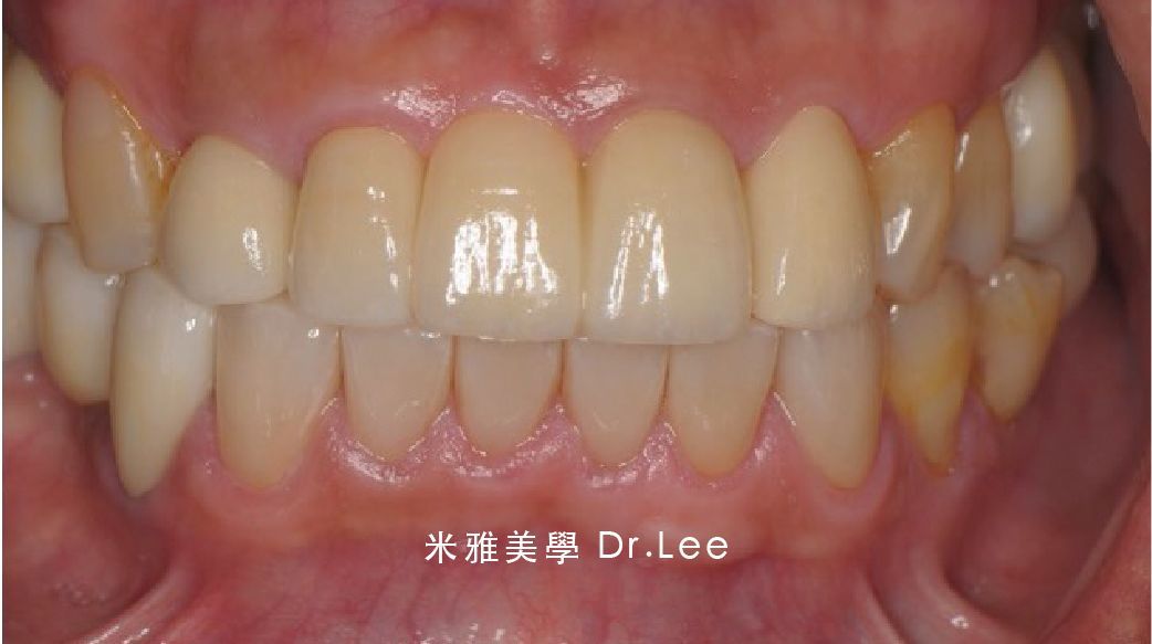 A close up of a person 's teeth with dr. lee written on the bottom