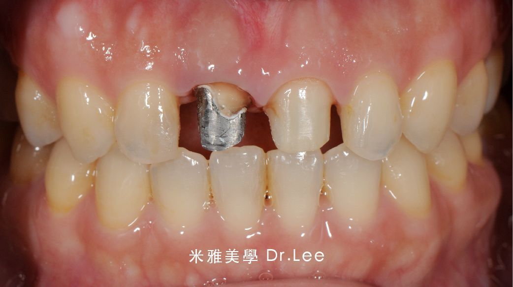 A close up of a person 's teeth with a tooth missing.