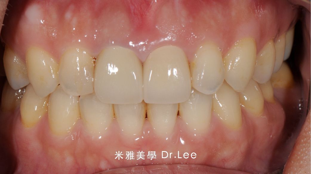 A close up of a person 's teeth with white teeth.