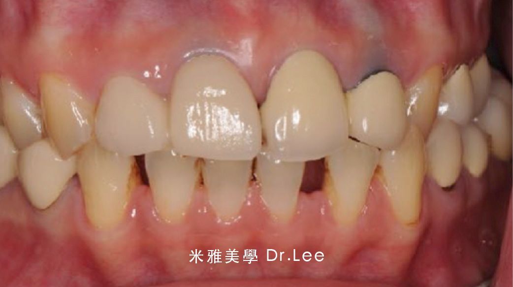 A close up of a person 's teeth with a missing tooth.