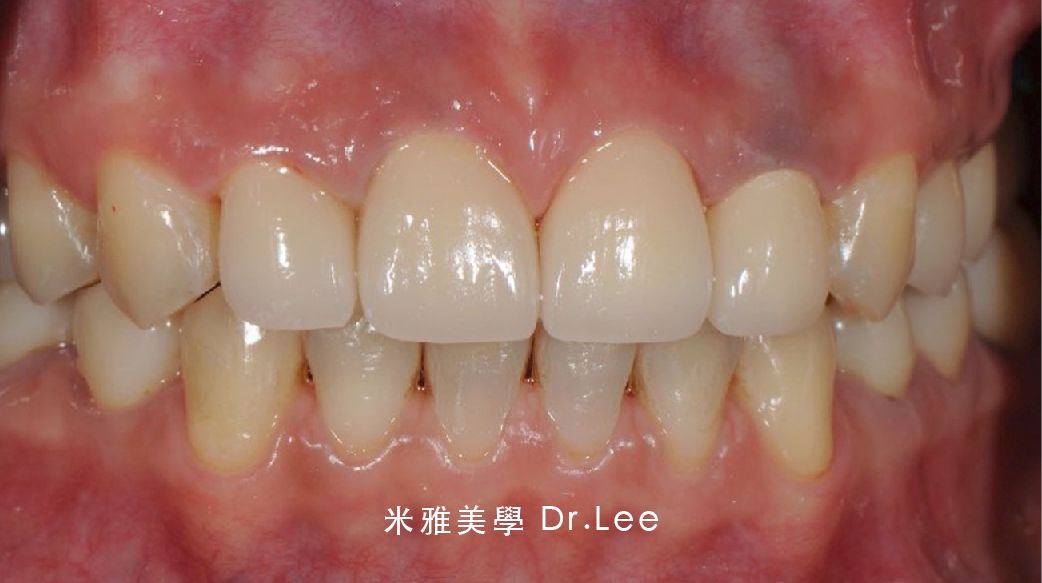 A close up of a person 's teeth and gums.