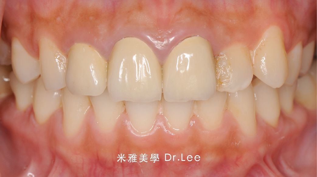 A close up of a person 's teeth with white teeth.