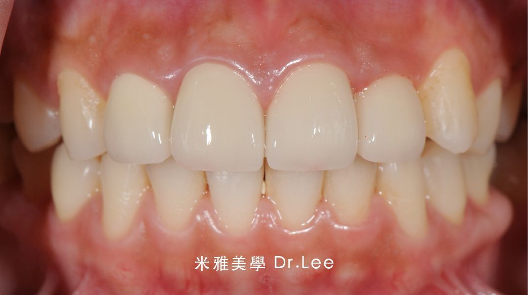 A close up of a person 's teeth with white teeth.