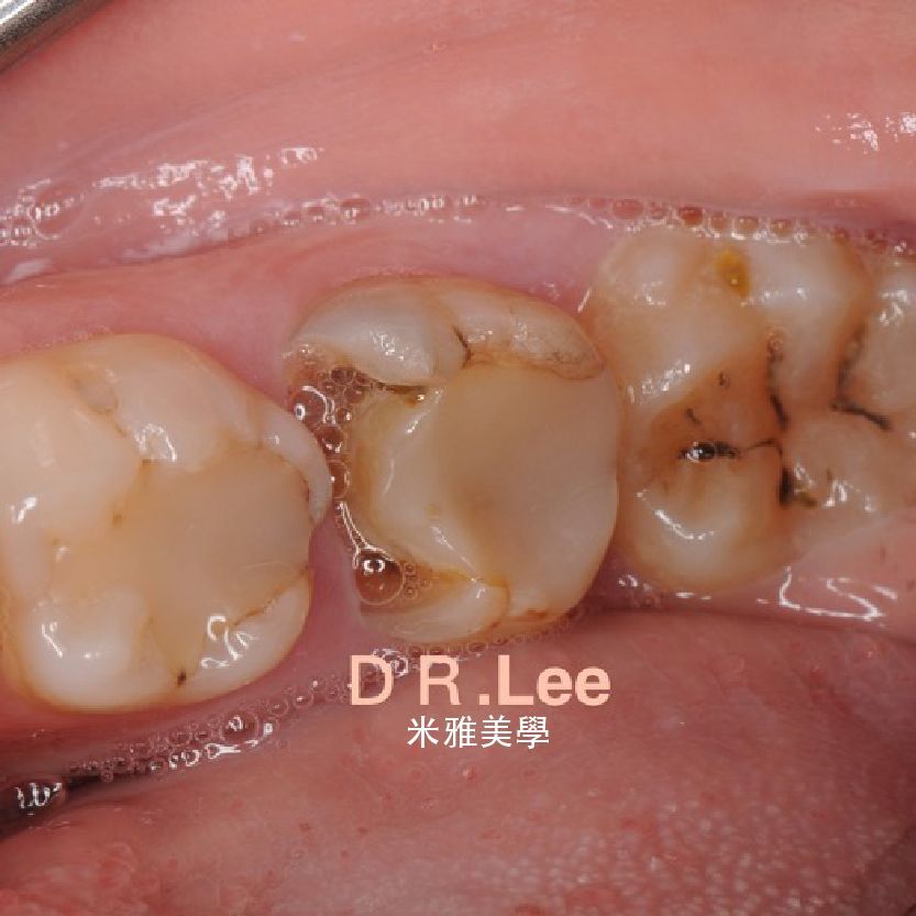 A close up of a person 's teeth with dr. lee written on the bottom