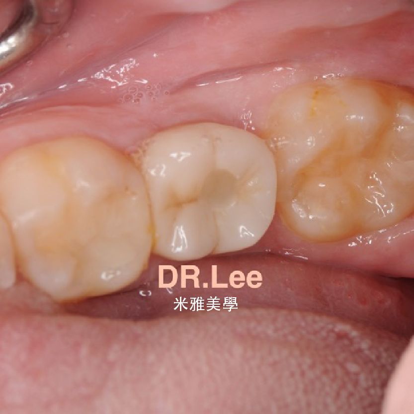 A close up of a person 's teeth with dr.lee written on the bottom