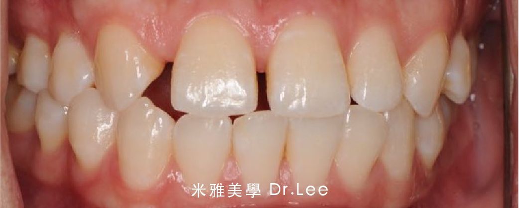 A close up of a person 's teeth with a missing tooth.