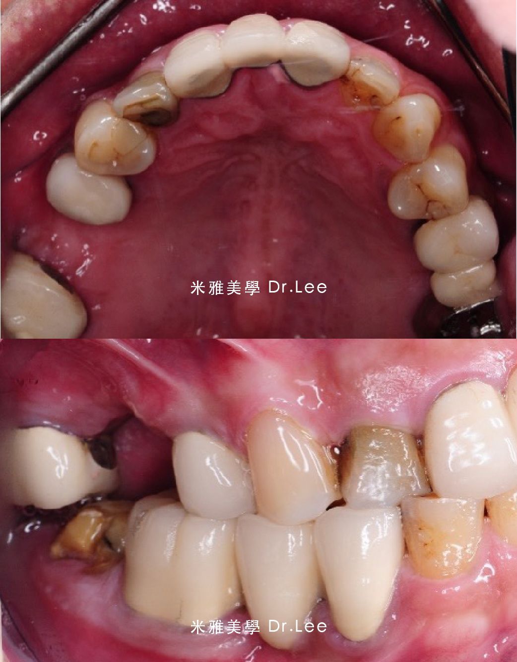 A before and after picture of a person 's teeth taken by dr lee