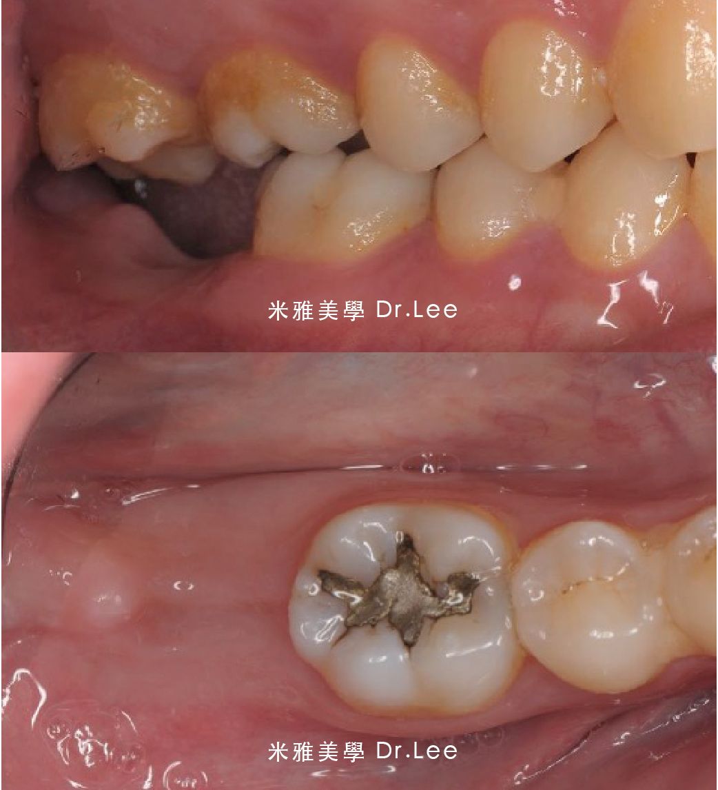 A before and after photo of a person 's teeth taken by dr. lee