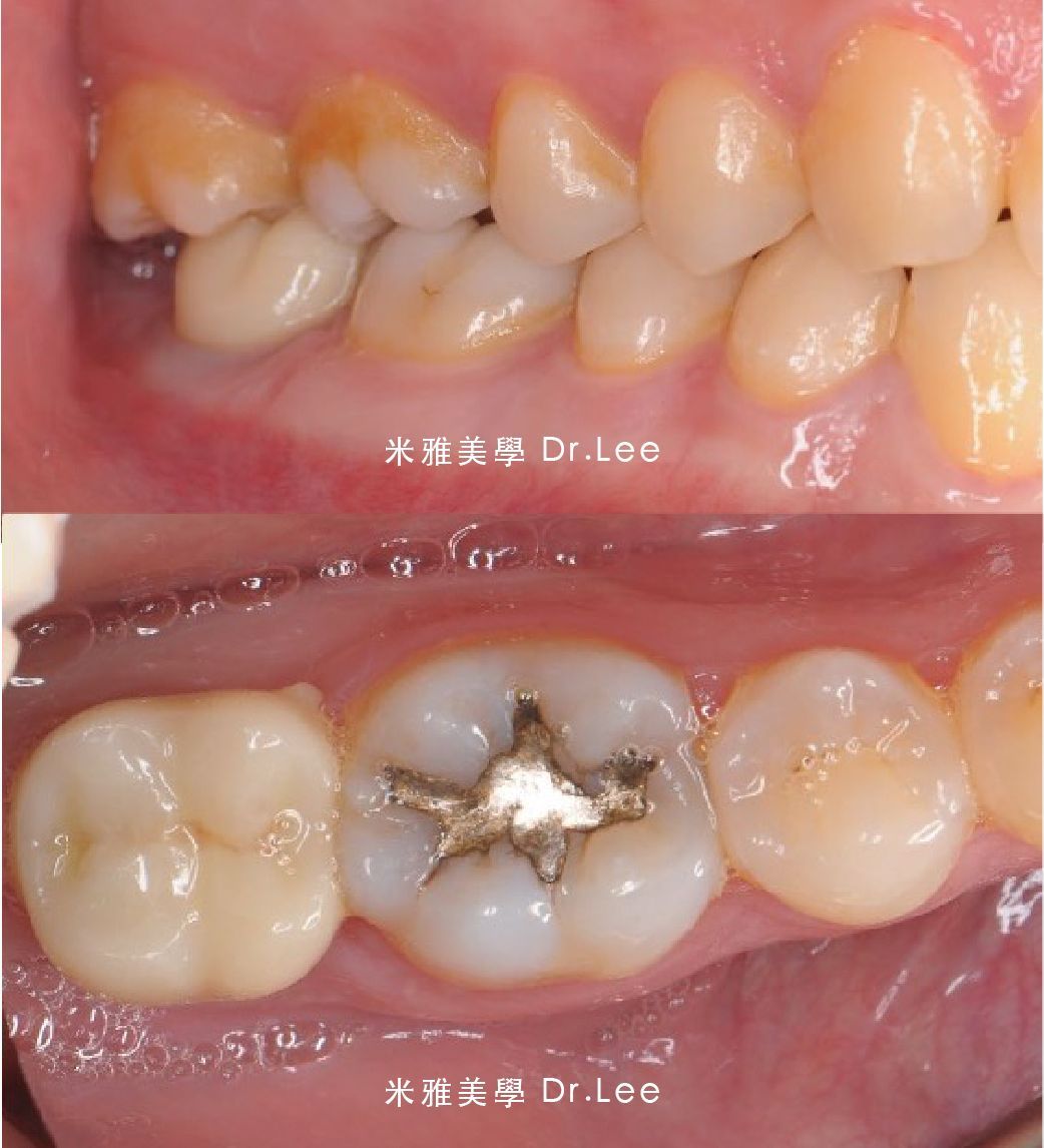 A before and after picture of a person 's teeth