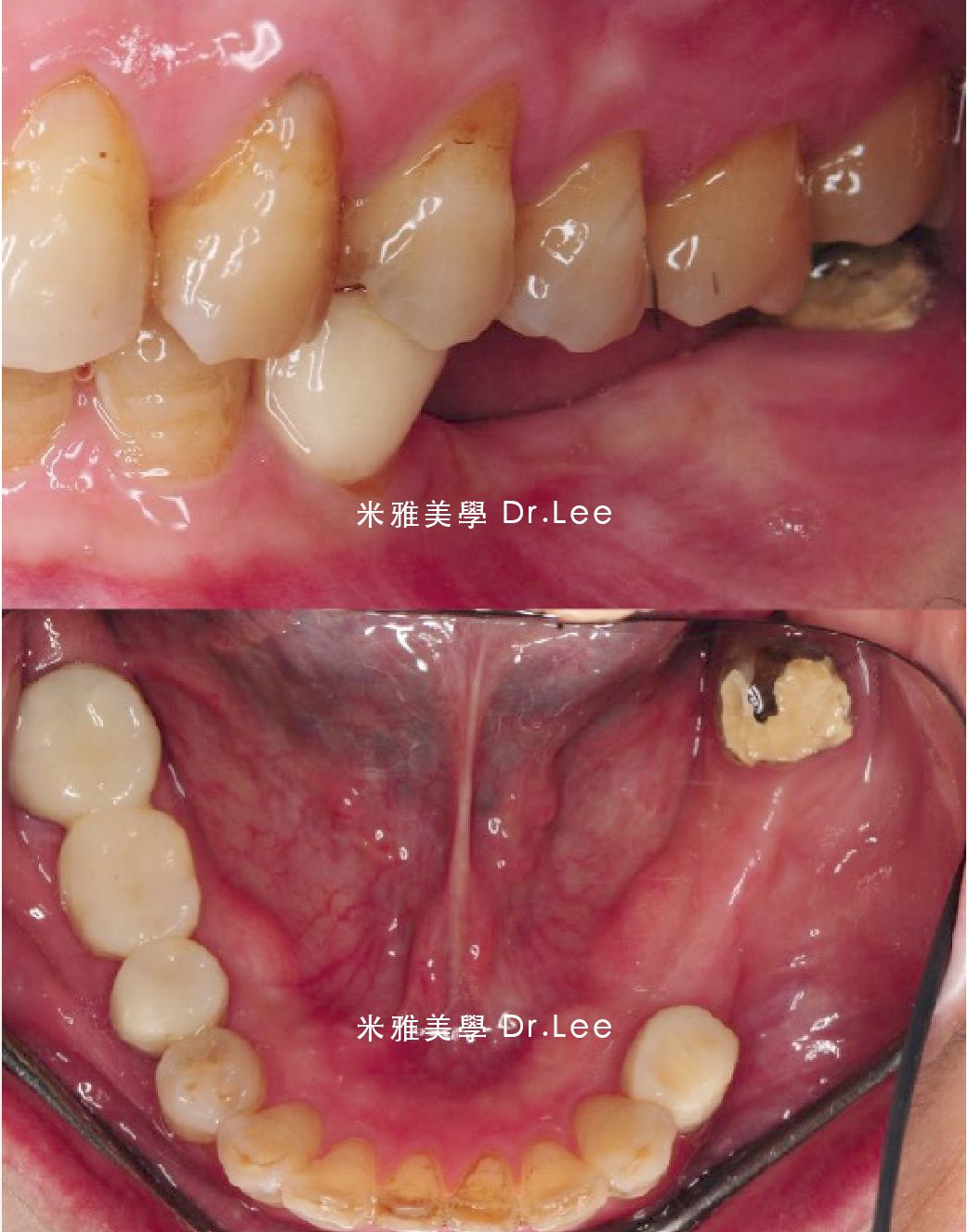 A close up of a person 's teeth with dr lee written on the bottom