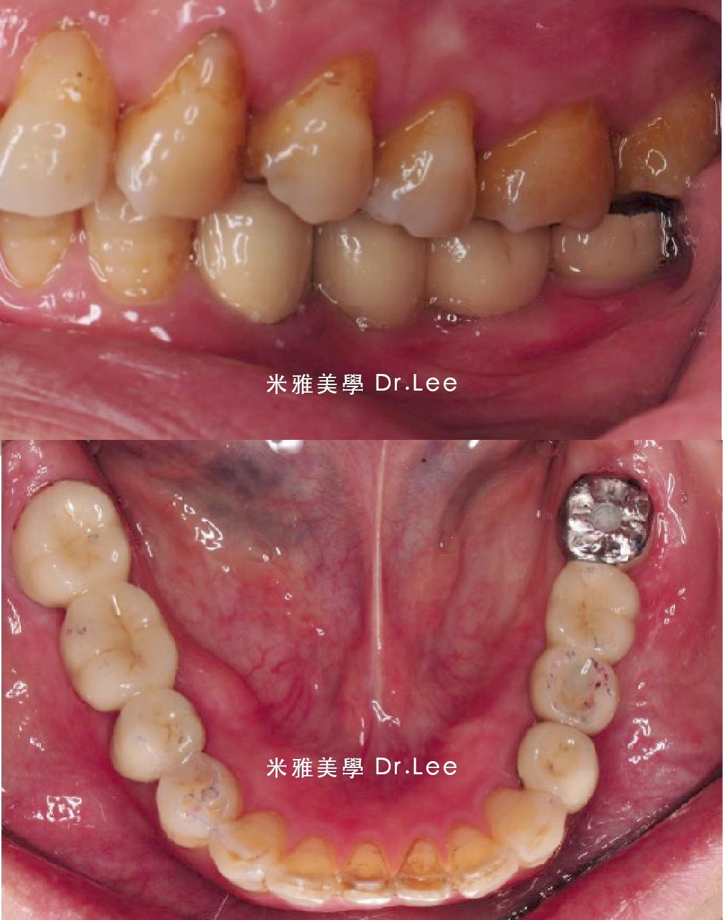 A close up of a person 's teeth taken by dr lee
