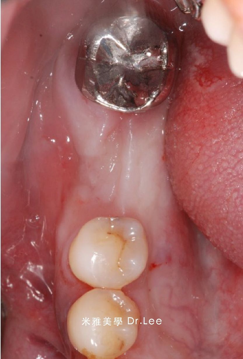 A close up of a person 's mouth with a tooth in it