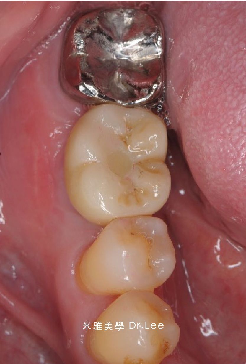 A close up of a tooth with a silver crown on it