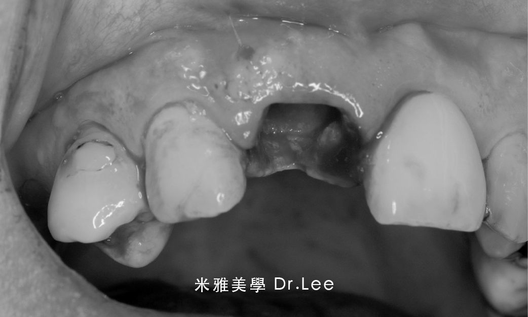 A black and white photo of a person 's mouth with a tooth missing