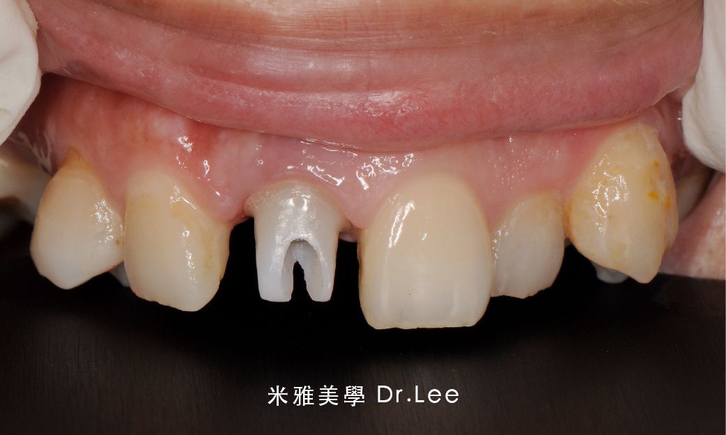 A close up of a person 's teeth with a missing tooth