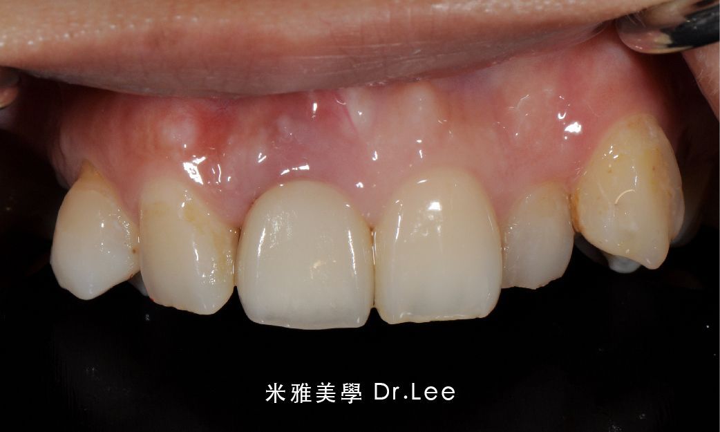 A close up of a person 's teeth with chinese writing
