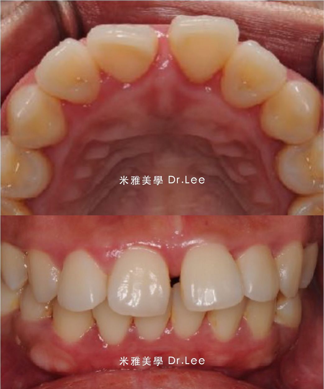 A close up of a person 's teeth taken by dr lee