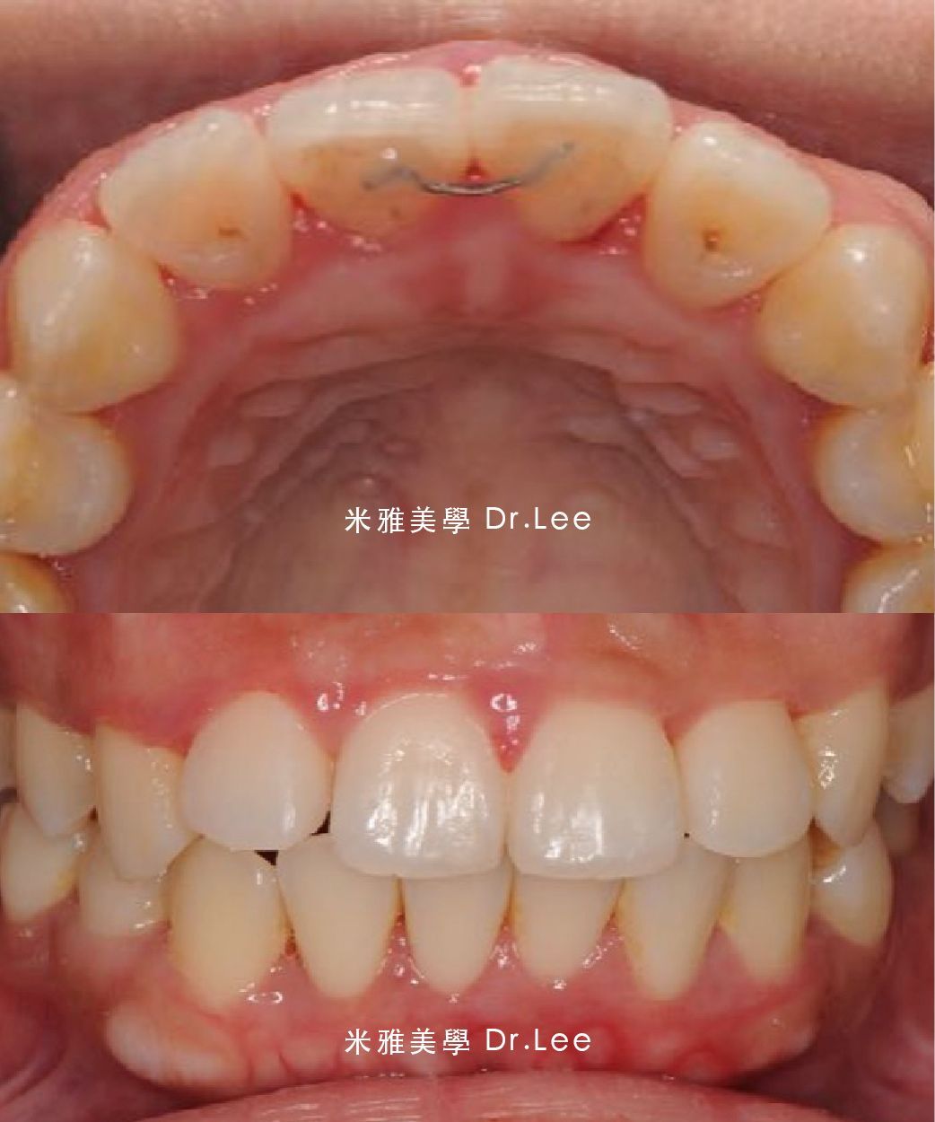 A before and after picture of a person 's teeth