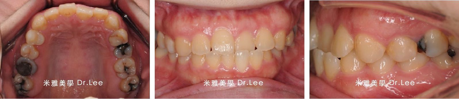 A close up of a person 's mouth showing their teeth.