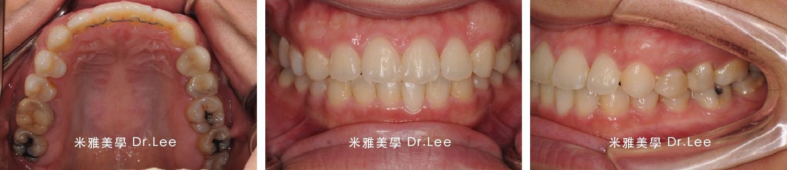 Three pictures of a person 's mouth showing different stages of their teeth.