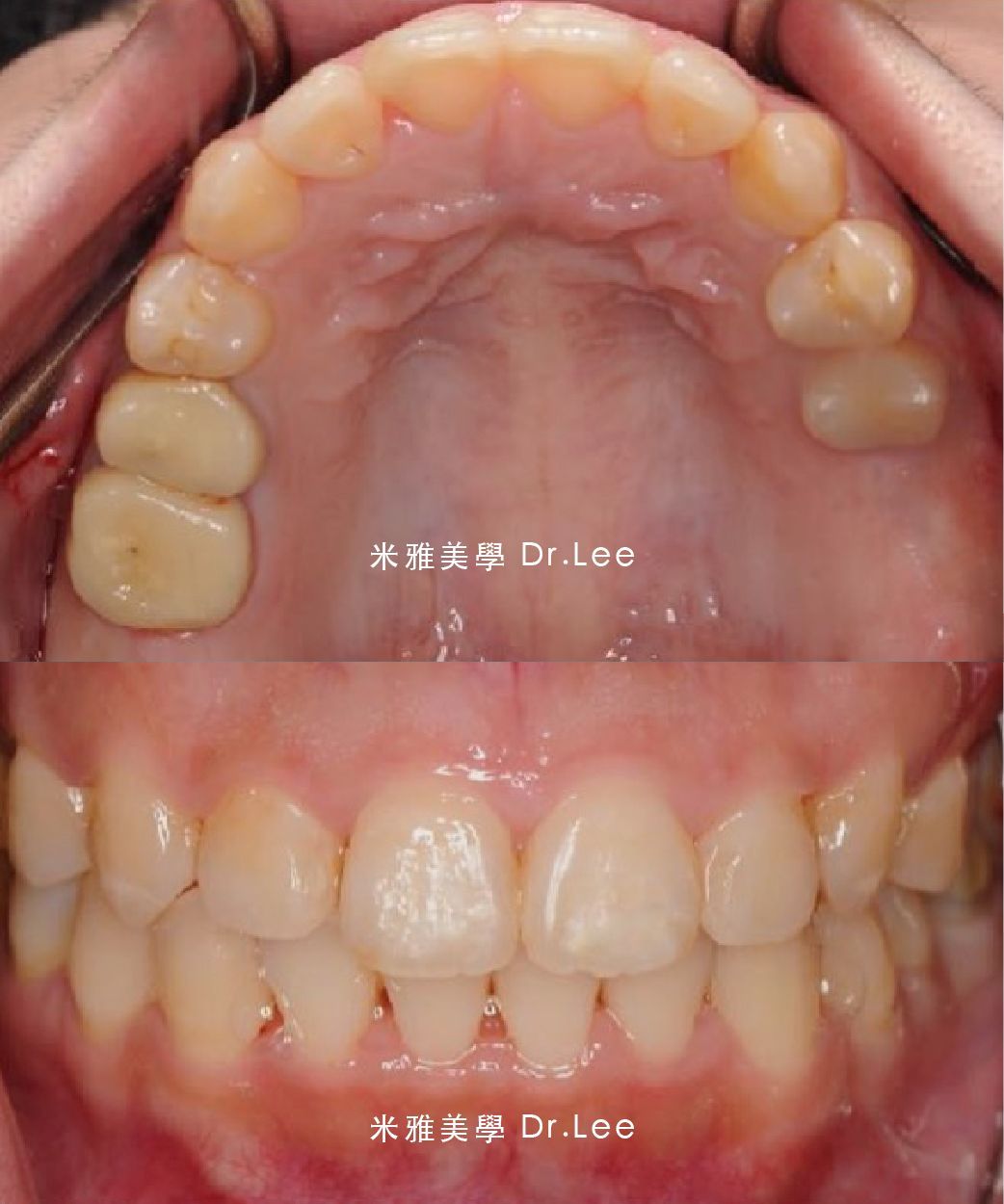A before and after picture of a person 's teeth