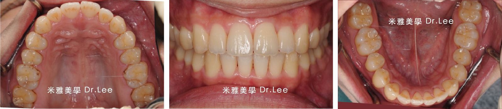 A close up of a person 's mouth with braces on their teeth.