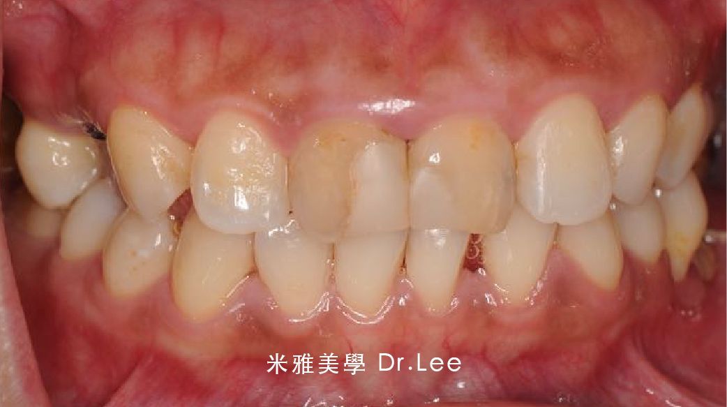 A close up of a person 's teeth with chinese writing on it.