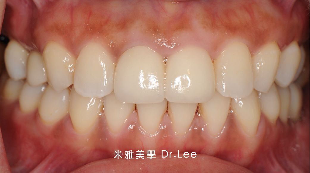 A close up of a person 's teeth with chinese writing on the bottom
